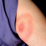 The Dangers of Lyme Disease